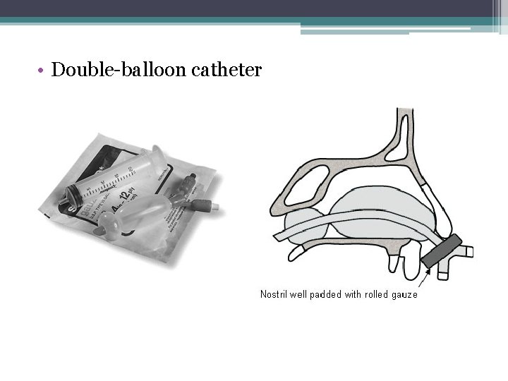  • Double-balloon catheter 