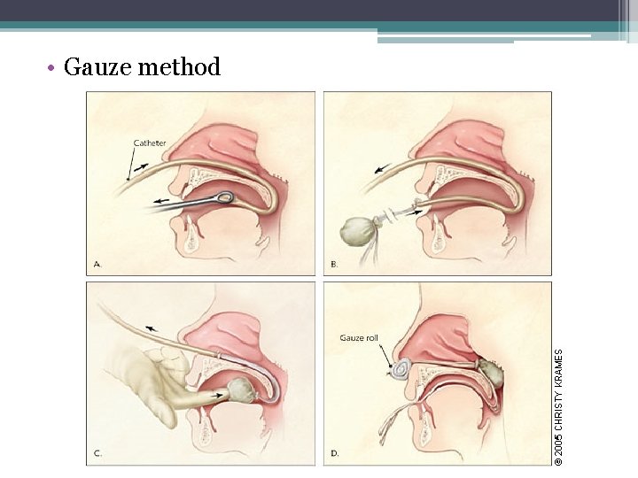  • Gauze method 