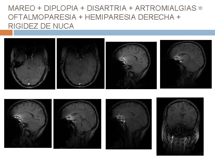 MAREO + DIPLOPIA + DISARTRIA + ARTROMIALGIAS = OFTALMOPARESIA + HEMIPARESIA DERECHA + RIGIDEZ