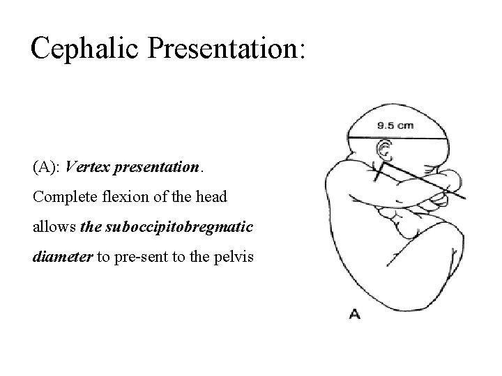 Cephalic Presentation: (A): Vertex presentation. Complete flexion of the head allows the suboccipitobregmatic diameter