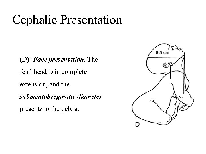 Cephalic Presentation (D): Face presentation. The fetal head is in complete extension, and the