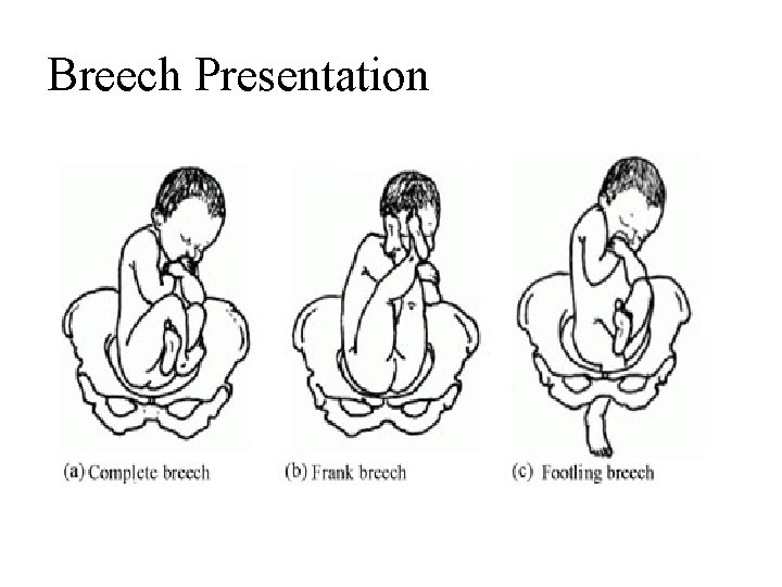 Breech Presentation 