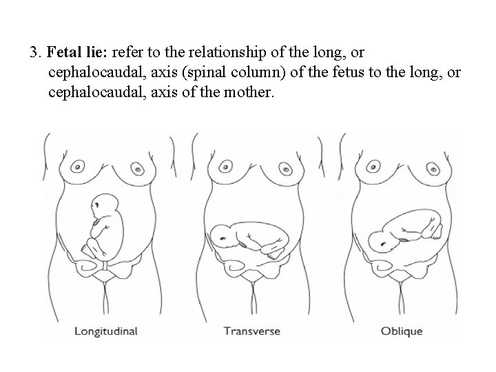 3. Fetal lie: refer to the relationship of the long, or cephalocaudal, axis (spinal