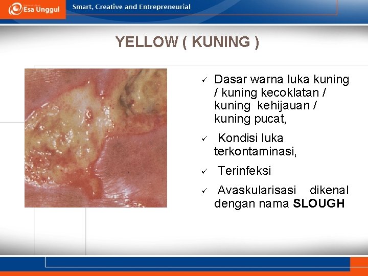 YELLOW ( KUNING ) Dasar warna luka kuning / kuning kecoklatan / kuning kehijauan