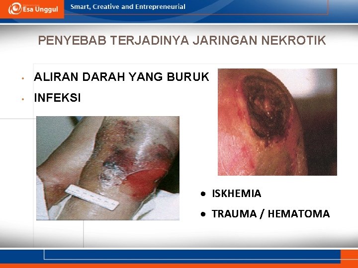 PENYEBAB TERJADINYA JARINGAN NEKROTIK • ALIRAN DARAH YANG BURUK • INFEKSI ISKHEMIA TRAUMA /