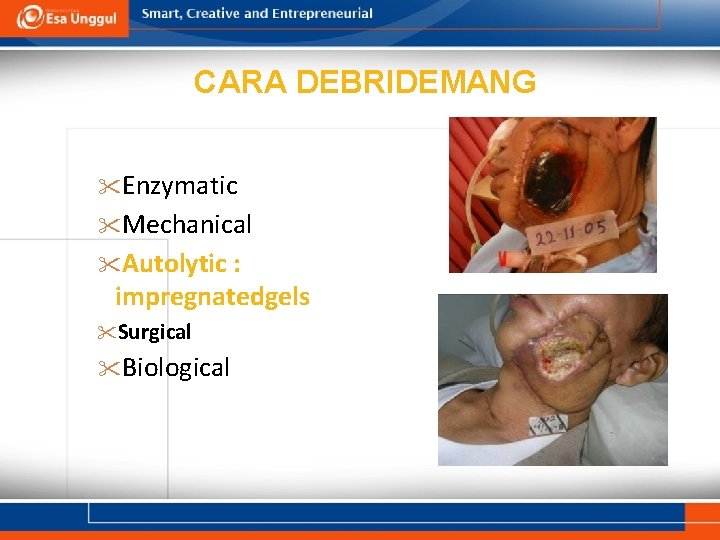 CARA DEBRIDEMANG Enzymatic Mechanical Autolytic : impregnatedgels Surgical Biological 