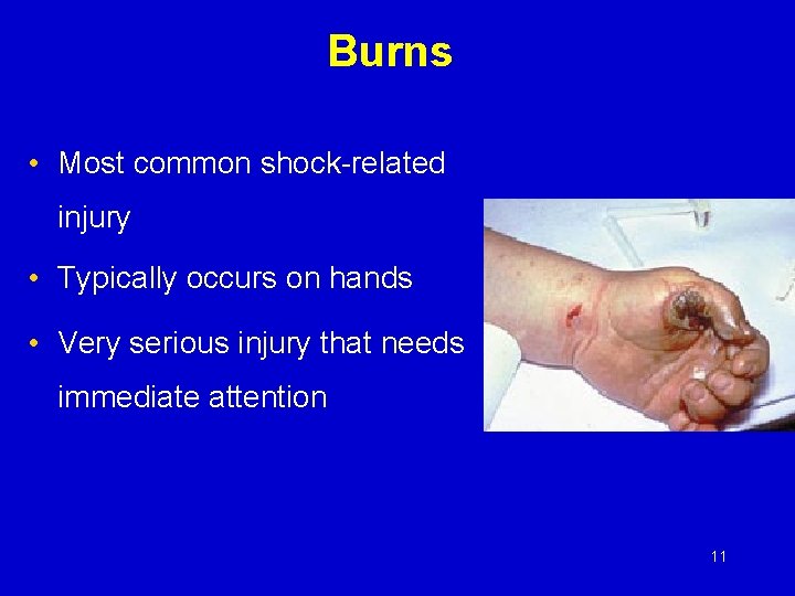 Burns • Most common shock-related injury • Typically occurs on hands • Very serious