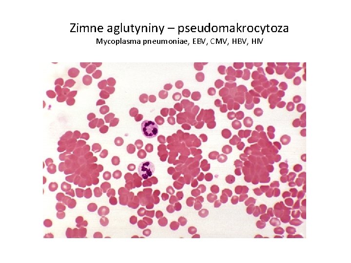 Zimne aglutyniny – pseudomakrocytoza Mycoplasma pneumoniae, EBV, CMV, HBV, HIV 