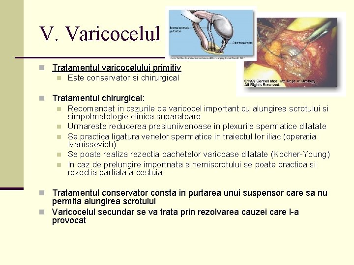 V. Varicocelul n Tratamentul varicocelului primitiv n Este conservator si chirurgical n Tratamentul chirurgical: