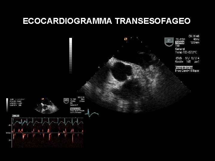 ECOCARDIOGRAMMA TRANSESOFAGEO 