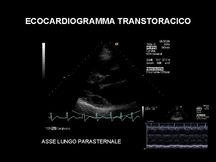 ECOCARDIOGRAMMA TRANSTORACICO ASSE LUNGO PARASTERNALE 