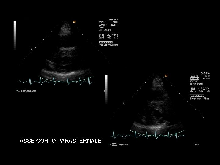 ASSE CORTO PARASTERNALE 