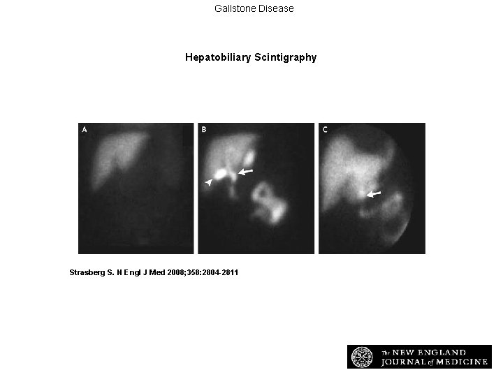 Gallstone Disease Hepatobiliary Scintigraphy Strasberg S. N Engl J Med 2008; 358: 2804 -2811