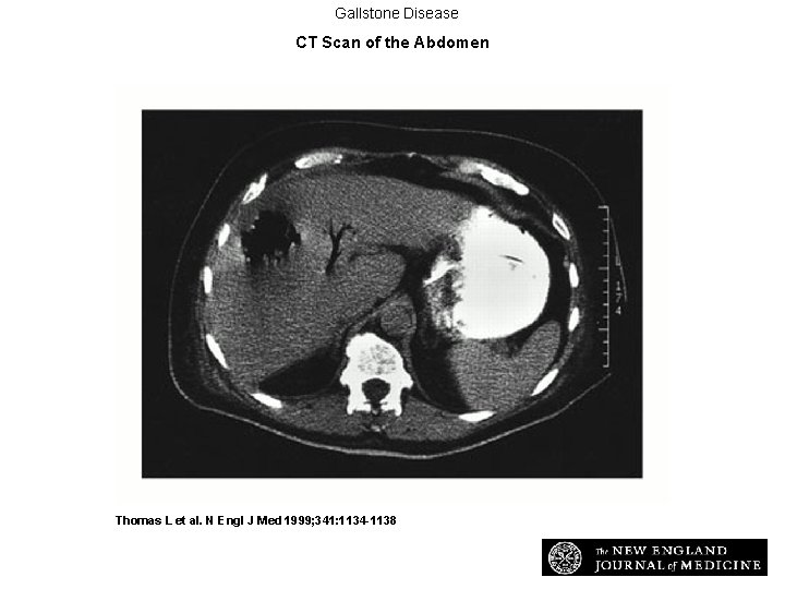 Gallstone Disease CT Scan of the Abdomen Thomas L et al. N Engl J