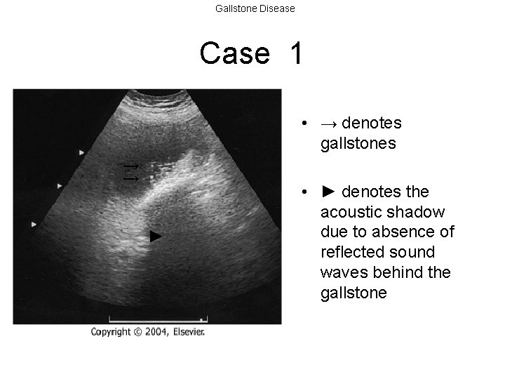 Gallstone Disease Case 1 • → denotes gallstones → → ► • ► denotes