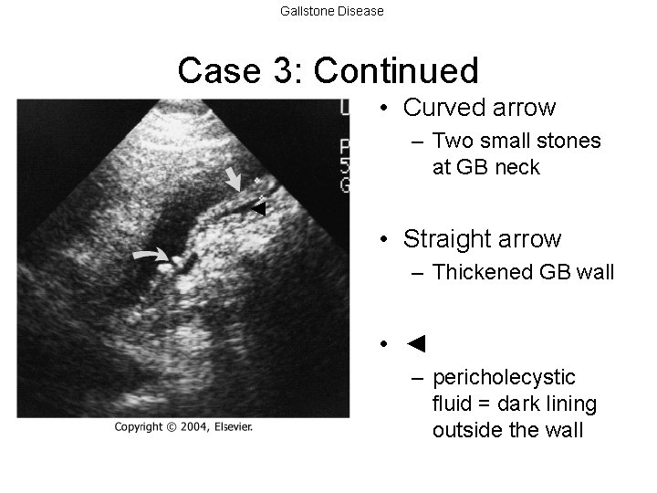 Gallstone Disease Case 3: Continued • Curved arrow – Two small stones at GB