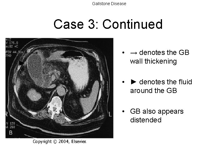 Gallstone Disease Case 3: Continued → ► • → denotes the GB wall thickening