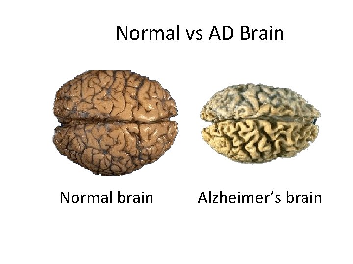 Normal vs AD Brain Normal brain Alzheimer’s brain 