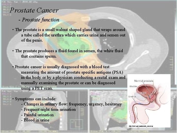 Prostate Cancer - Prostate function • The prostate is a small walnut shaped gland