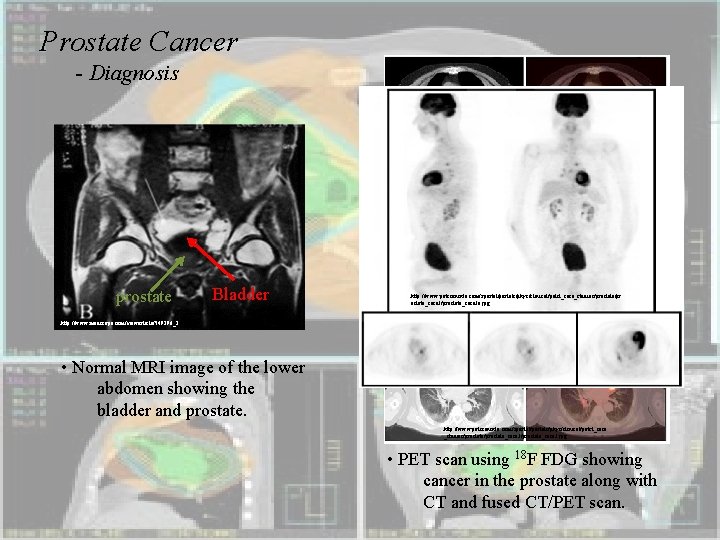 Prostate Cancer - Diagnosis prostate Bladder http: //www. petscaninfo. com/zportal/portals/phys/clinical/petct_case_studies/prostate/pr ostate_case 3/prostate_case 3 a.