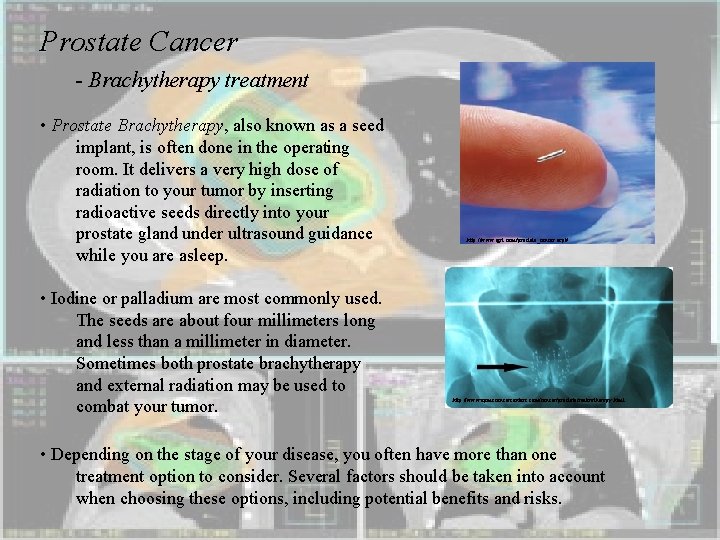 Prostate Cancer - Brachytherapy treatment • Prostate Brachytherapy, also known as a seed implant,