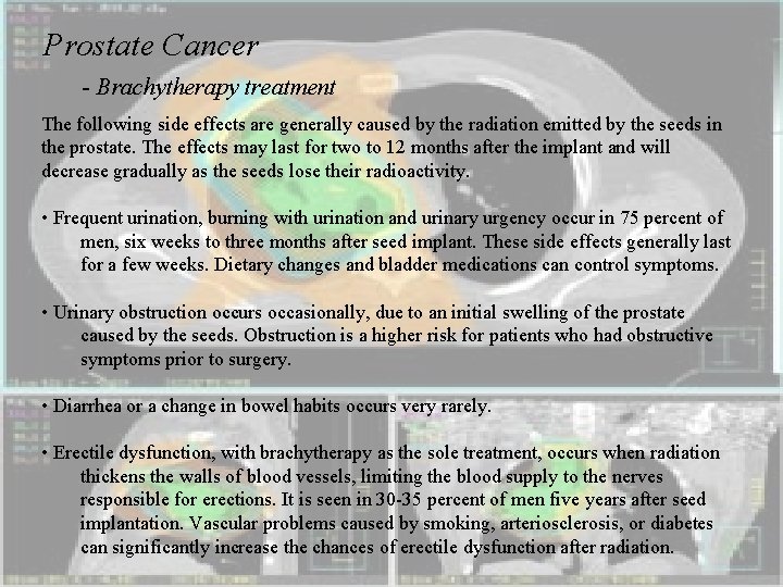 Prostate Cancer - Brachytherapy treatment The following side effects are generally caused by the