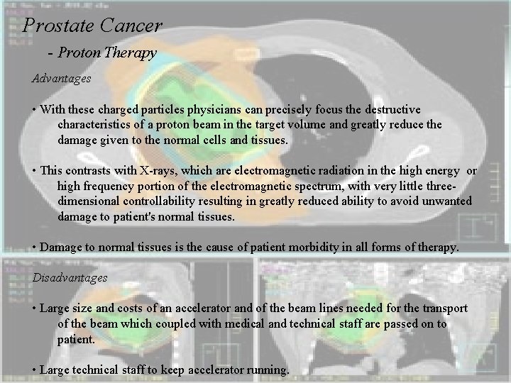 Prostate Cancer - Proton Therapy Advantages • With these charged particles physicians can precisely