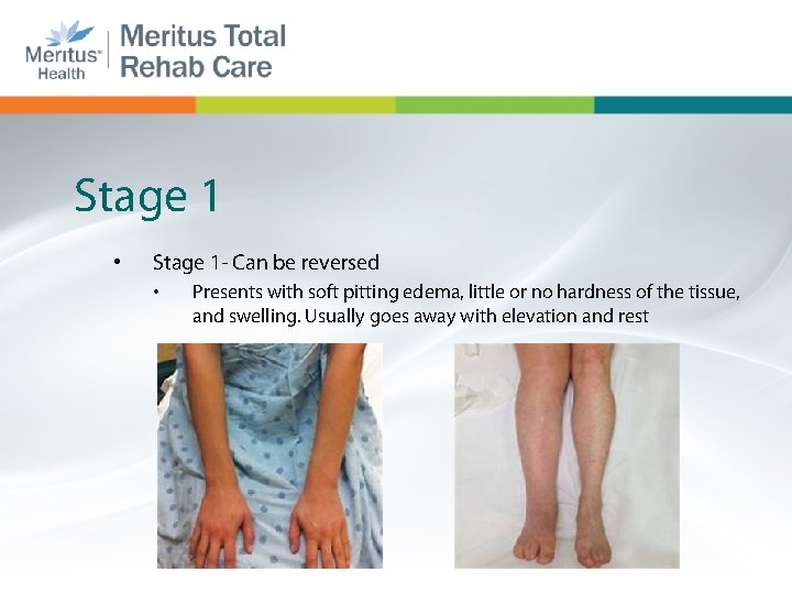 Stage 1 • Stage 1 - Can be reversed • Presents with soft pitting