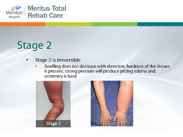 Stage 2 • Stage 2 -Is irreversible • Swelling does not decrease with elevation,