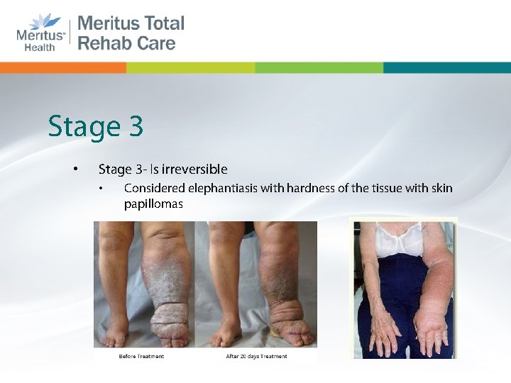 Stage 3 • Stage 3 - Is irreversible • Considered elephantiasis with hardness of
