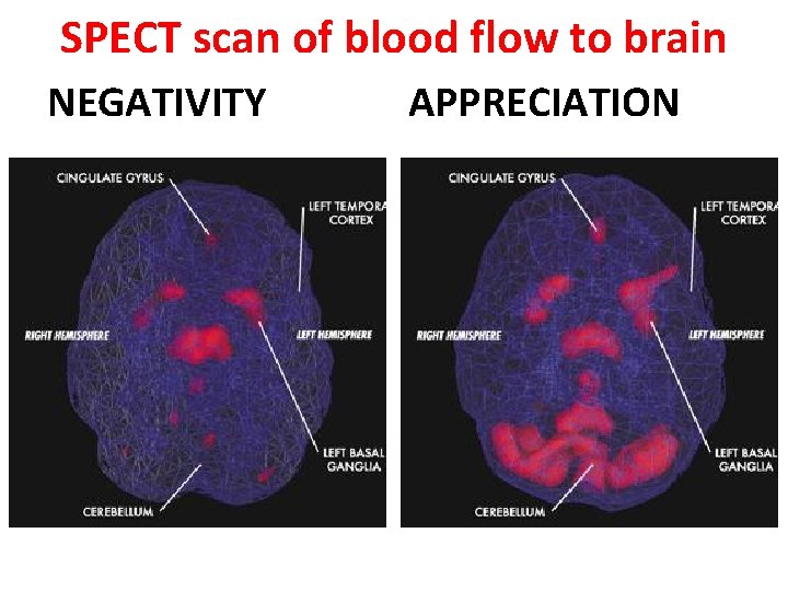 SPECT scan of blood flow to brain NEGATIVITY APPRECIATION 
