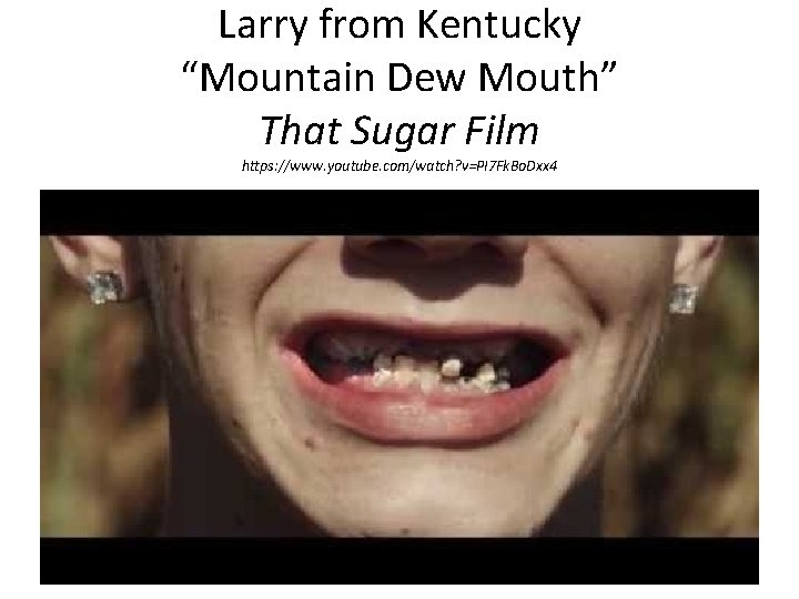 Larry from Kentucky “Mountain Dew Mouth” That Sugar Film https: //www. youtube. com/watch? v=PI
