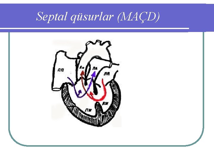 Septal qüsurlar (MAÇD) 