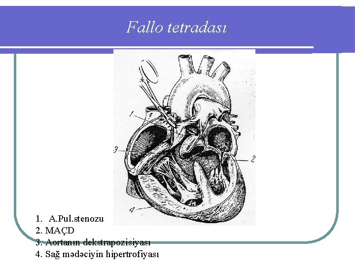Fallo tetradası 1. A. Pul. stenozu 2. MAÇD 3. Aortanın dekstrapozisiyası 4. Sağ mədəciyin