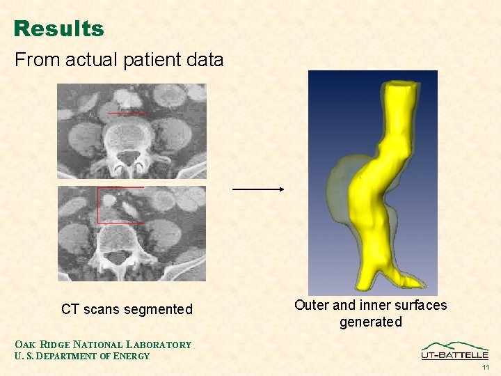 Results From actual patient data CT scans segmented Outer and inner surfaces generated OAK
