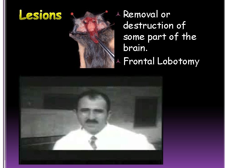  Removal or destruction of some part of the brain. Frontal Lobotomy 