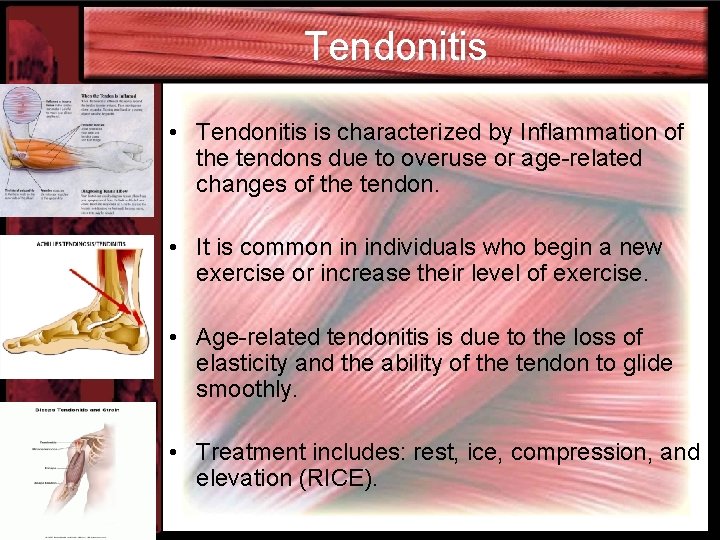 Tendonitis • Tendonitis is characterized by Inflammation of the tendons due to overuse or