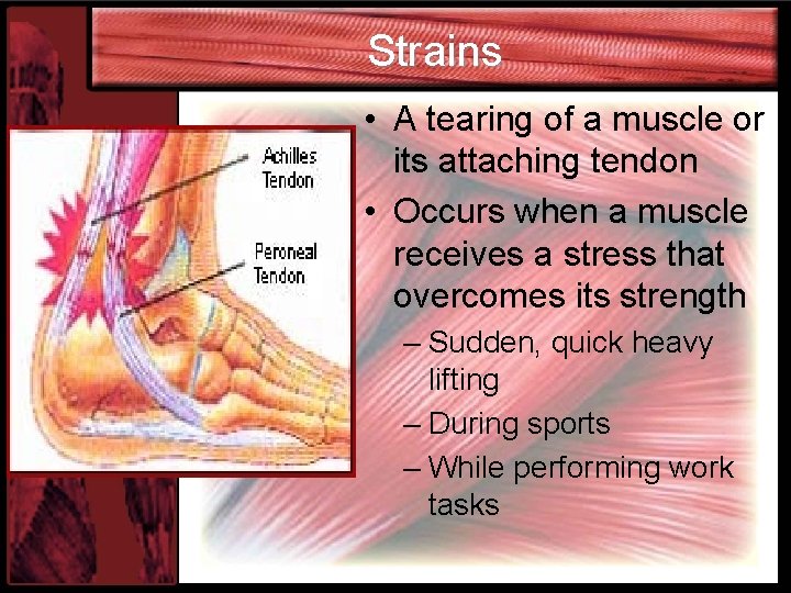 Strains • A tearing of a muscle or its attaching tendon • Occurs when