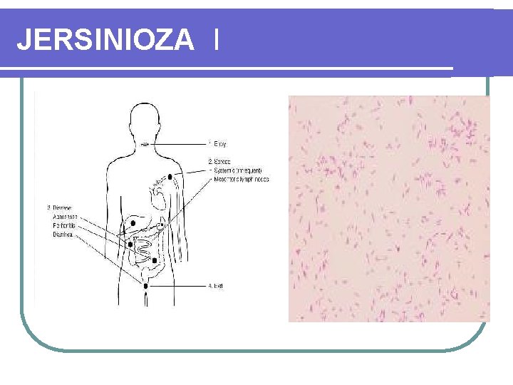 JERSINIOZA I 