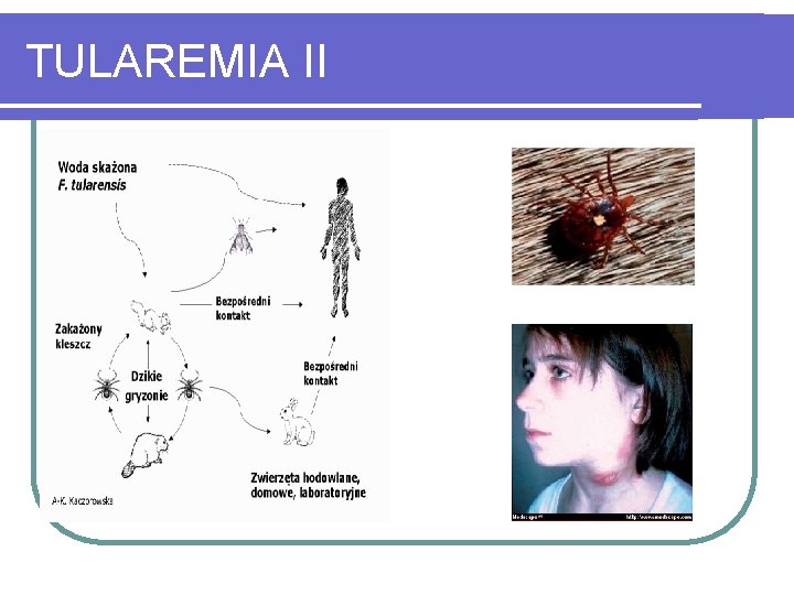 TULAREMIA II 