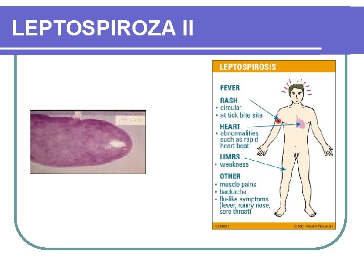 LEPTOSPIROZA II 