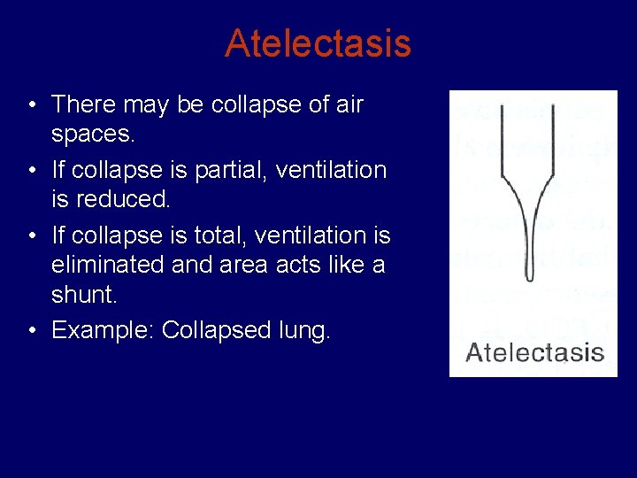 Atelectasis • There may be collapse of air spaces. • If collapse is partial,