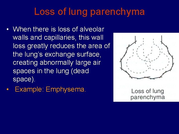 Loss of lung parenchyma • When there is loss of alveolar walls and capillaries,