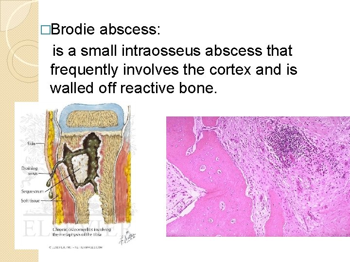 �Brodie abscess: is a small intraosseus abscess that frequently involves the cortex and is