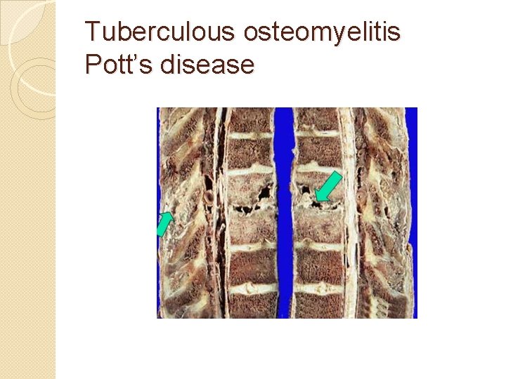 Tuberculous osteomyelitis Pott’s disease 