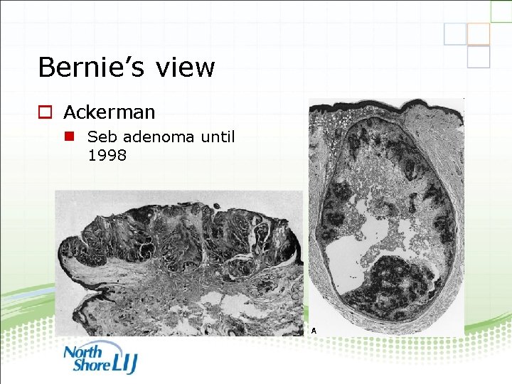 Bernie’s view o Ackerman n Seb adenoma until 1998 