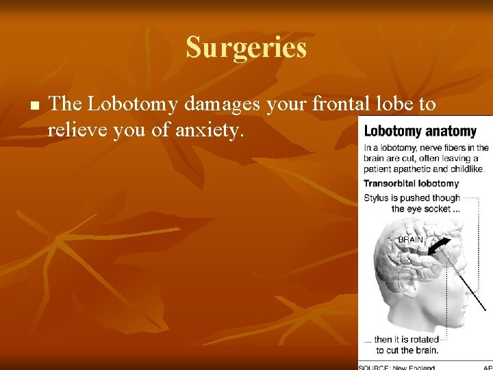 Surgeries n The Lobotomy damages your frontal lobe to relieve you of anxiety. 