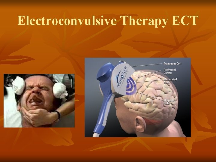 Electroconvulsive Therapy ECT 