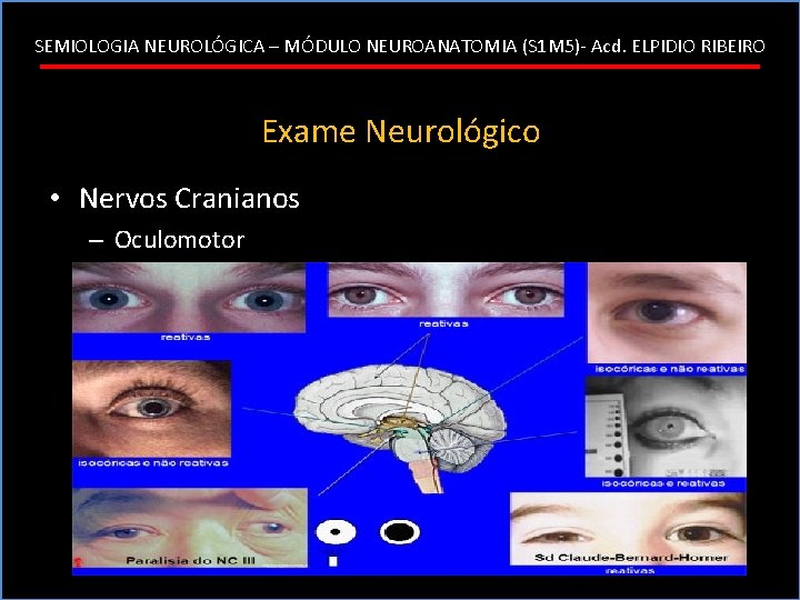 SEMIOLOGIA NEUROLÓGICA – MÓDULO NEUROANATOMIA (S 1 M 5)- Acd. ELPIDIO RIBEIRO Exame Neurológico