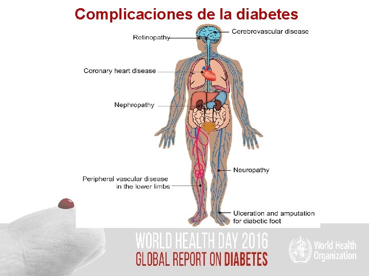 Complicaciones de la diabetes 